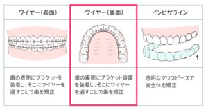 八重歯の全体矯正の表3